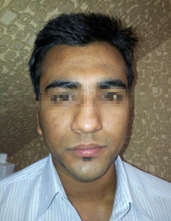 Skin after laser treatment