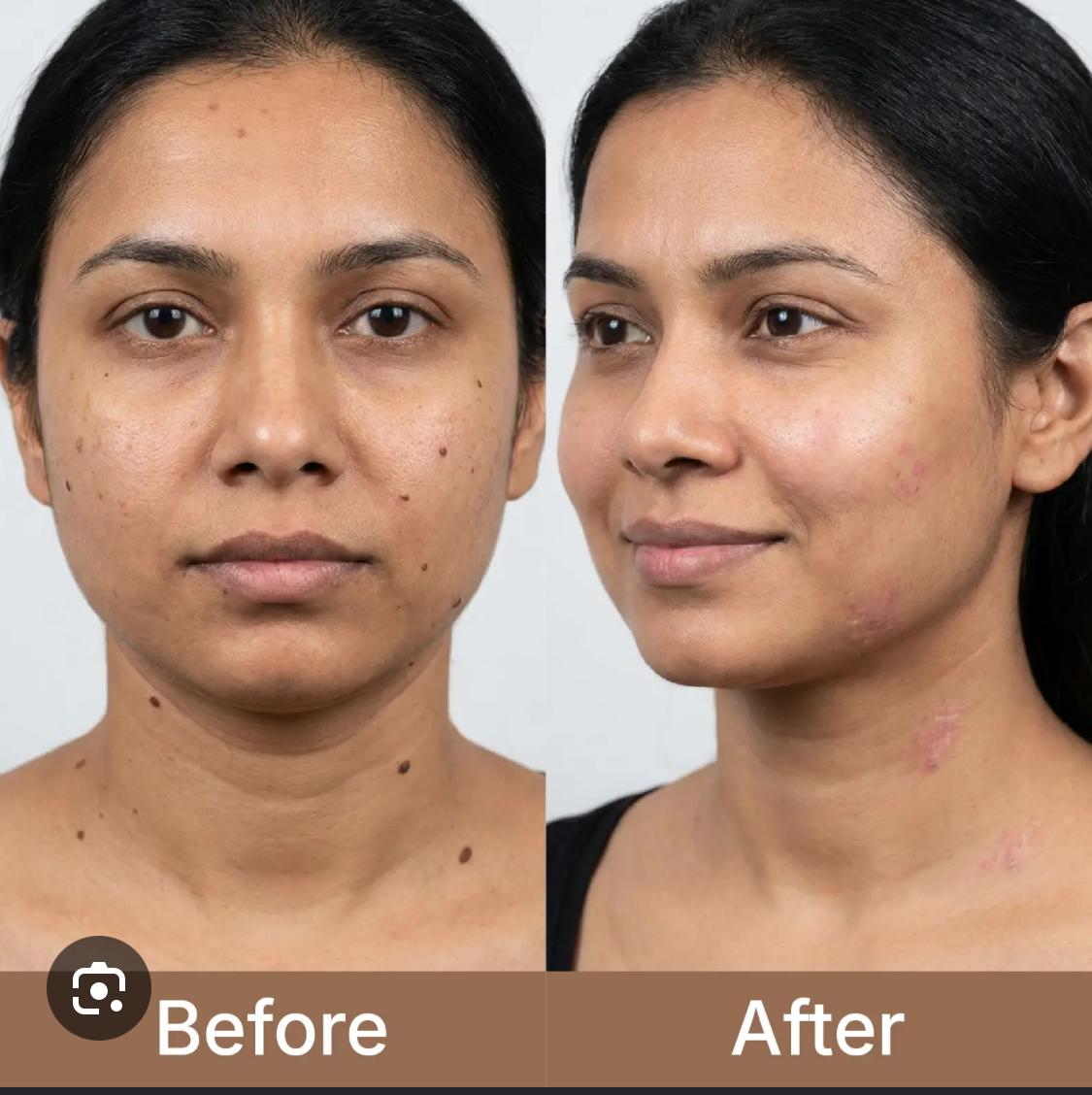 Mole Removal Before & After