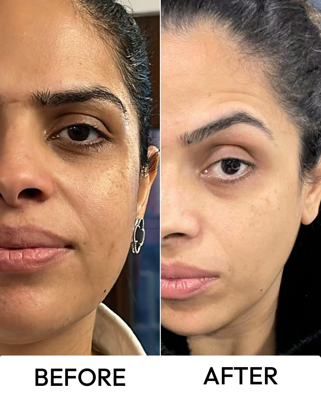 Dark Spot & Pigmentation Facial